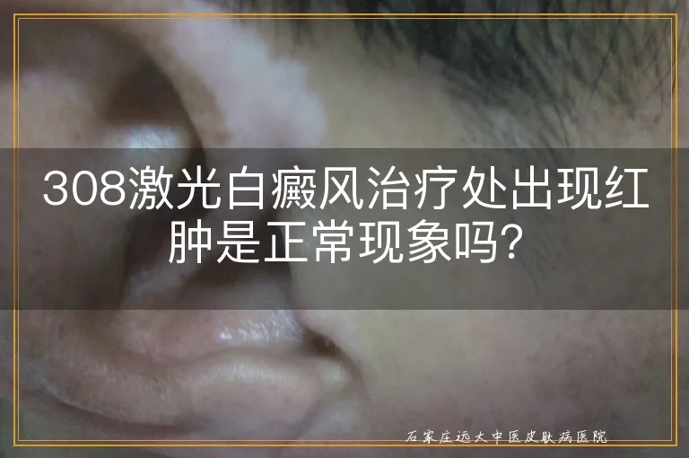 308激光白癜风治疗处出现红肿是正常现象吗？