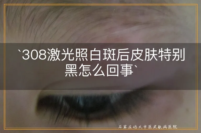 `308激光照白斑后皮肤特别黑怎么回事`