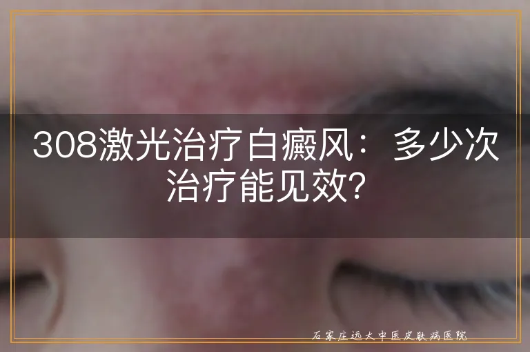 308激光治疗白癜风：多少次治疗能见效？