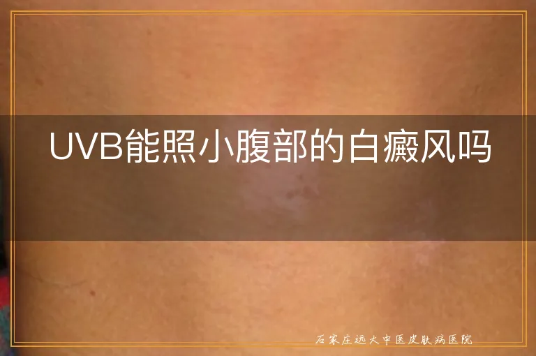 UVB能照小腹部的白癜风吗