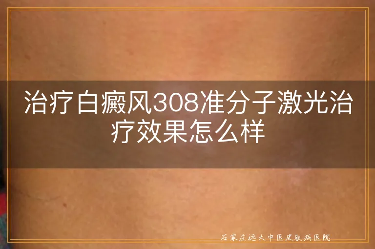 治疗白癜风308准分子激光治疗效果怎么样