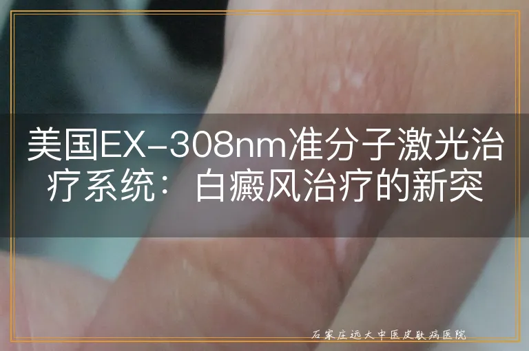 美国EX-308nm准分子激光治疗系统：白癜风治疗的新突破