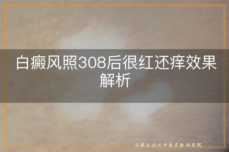 白癜风照308后很红还痒效果解析