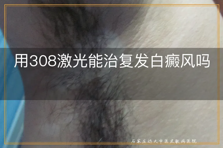 用308激光能治复发白癜风吗