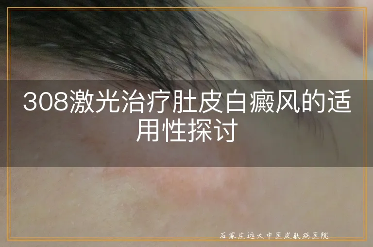 308激光治疗肚皮白癜风的适用性探讨