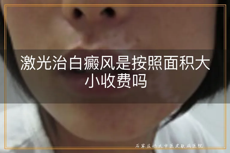 激光治白癜风是按照面积大小收费吗