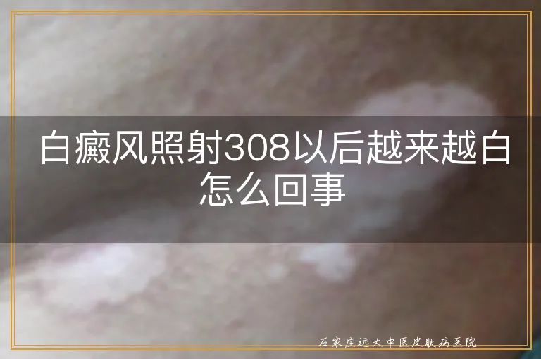 白癜风照射308以后越来越白怎么回事