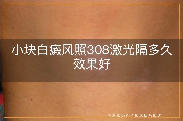 小块白癜风照308激光隔多久效果好