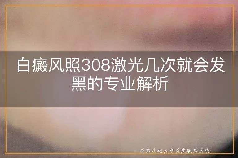 白癜风照308激光几次就会发黑的专业解析