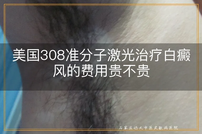 美国308准分子激光治疗白癜风的费用贵不贵