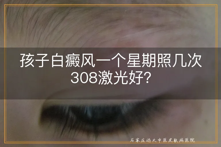 孩子白癜风一个星期照几次308激光好？