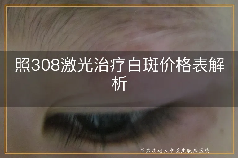 照308激光治疗白斑价格表解析