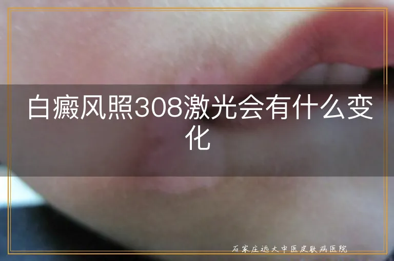 白癜风照308激光会有什么变化