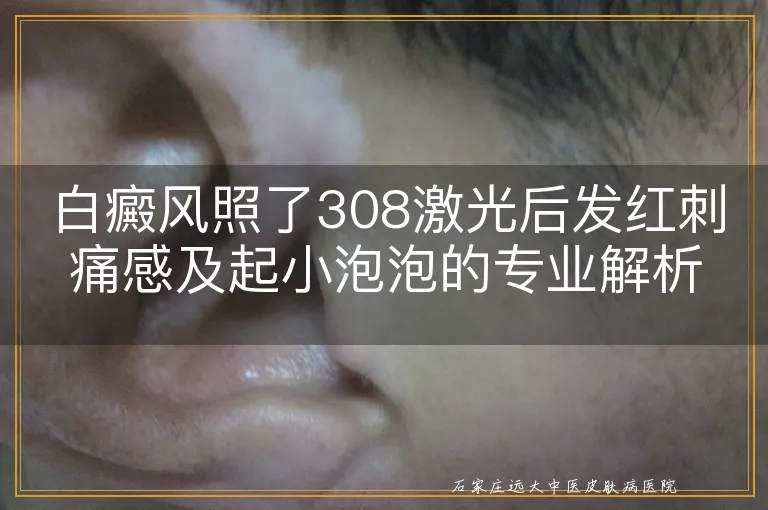 白癜风照了308激光后发红刺痛感及起小泡泡的专业解析