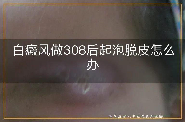 白癜风做308后起泡脱皮怎么办