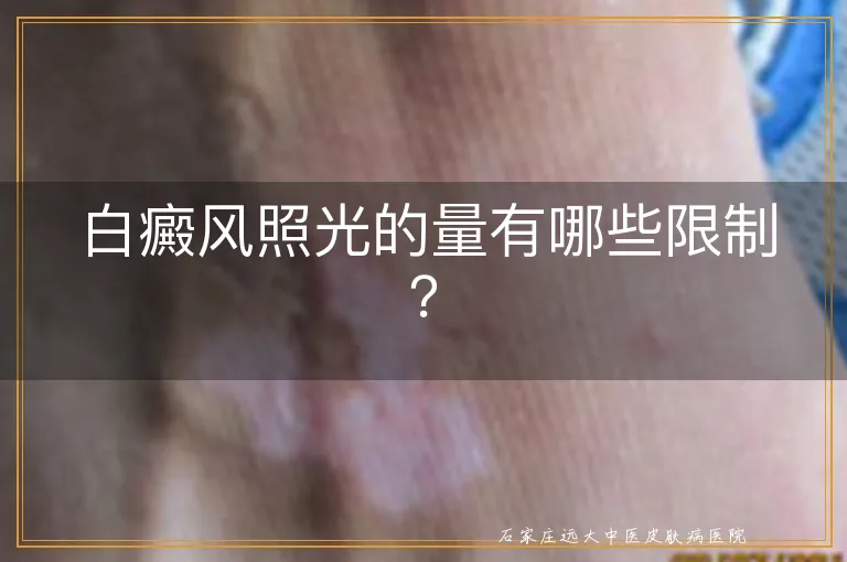 白癜风照光的量有哪些限制？