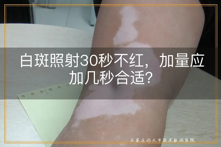 白斑照射30秒不红，加量应加几秒合适？