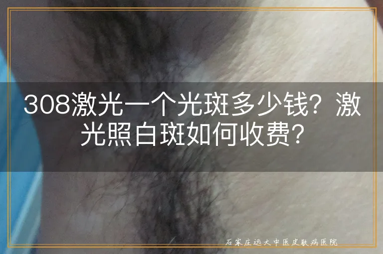 308激光一个光斑多少钱？激光照白斑如何收费？