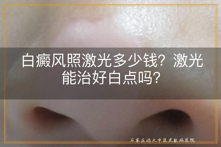 白癜风照激光多少钱？激光能治好白点吗？