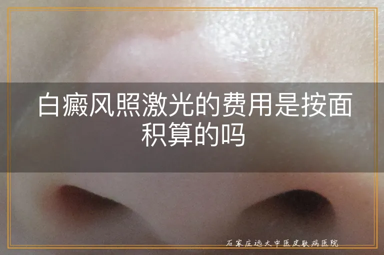 白癜风照激光的费用是按面积算的吗