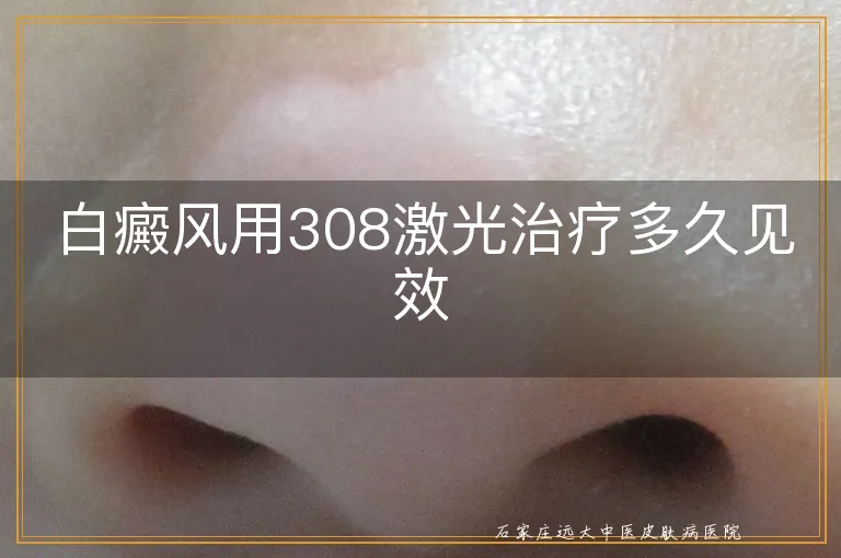 白癜风用308激光治疗多久见效