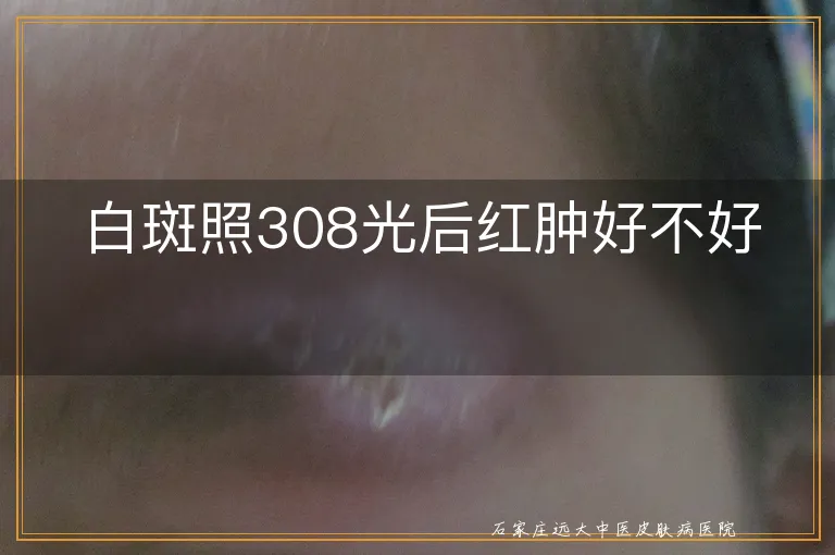 白斑照308光后红肿好不好