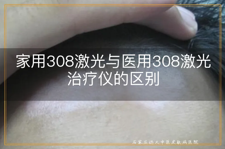 家用308激光与医用308激光治疗仪的区别