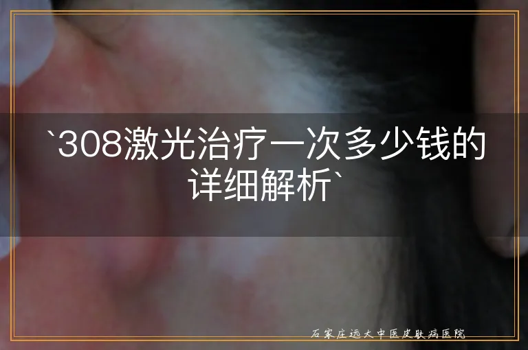 `308激光治疗一次多少钱的详细解析`