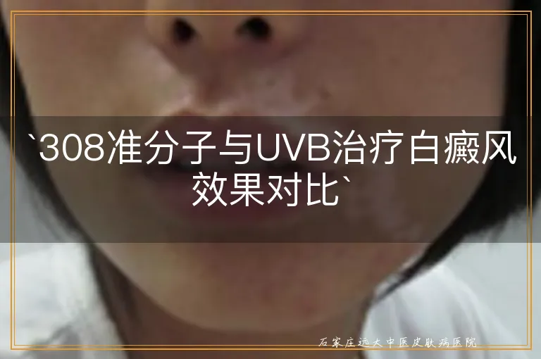 `308准分子与UVB治疗白癜风效果对比`