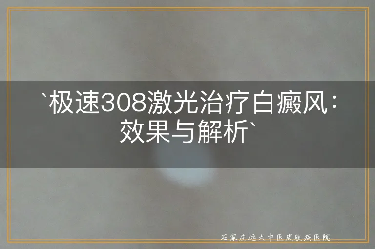 `极速308激光治疗白癜风：效果与解析`