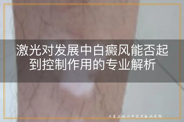 激光对发展中白癜风能否起到控制作用的专业解析