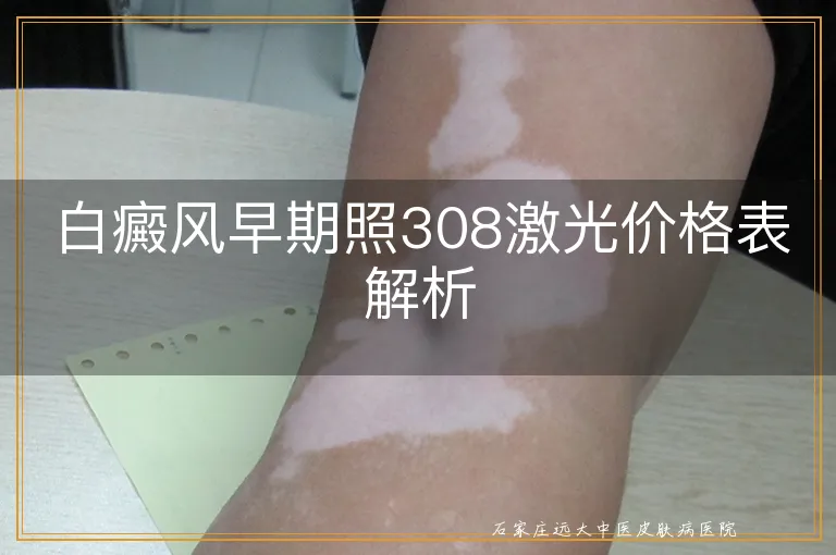 白癜风早期照308激光价格表解析