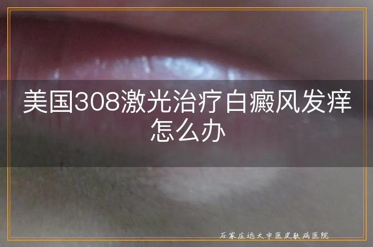 美国308激光治疗白癜风发痒怎么办