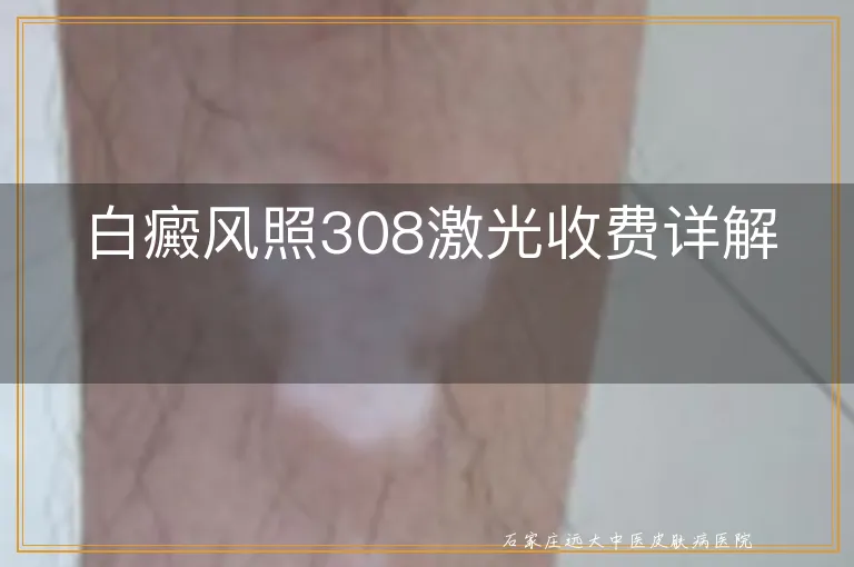 白癜风照308激光收费详解