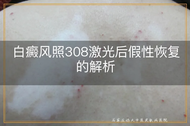 白癜风照308激光后假性恢复的解析