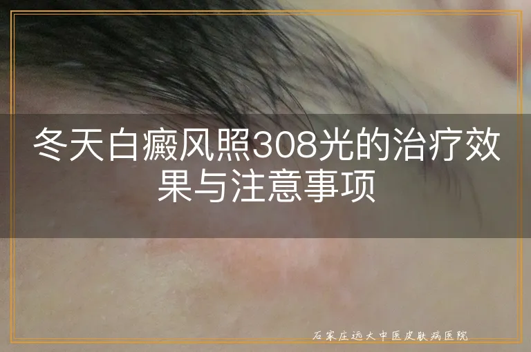 冬天白癜风照308光的治疗效果与注意事项