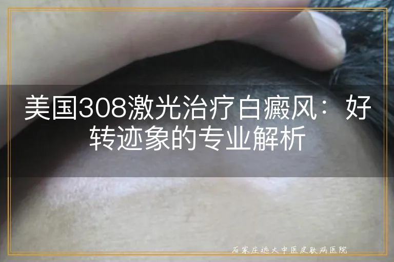 美国308激光治疗白癜风：好转迹象的专业解析