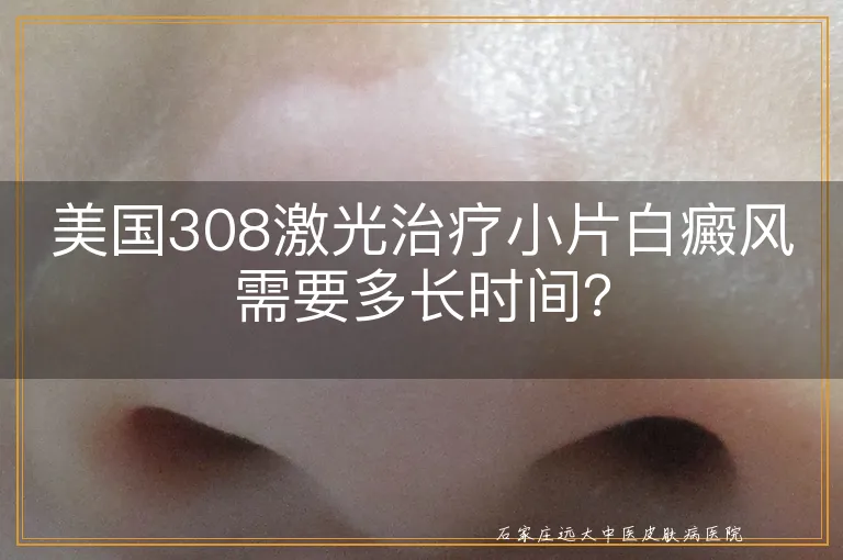 美国308激光治疗小片白癜风需要多长时间？