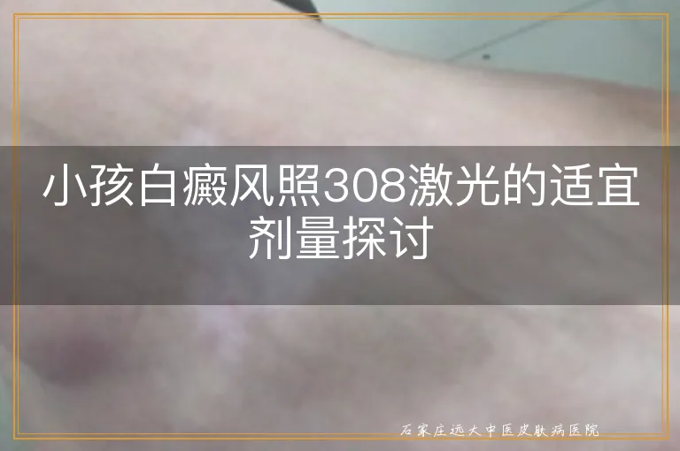 小孩白癜风照308激光的适宜剂量探讨