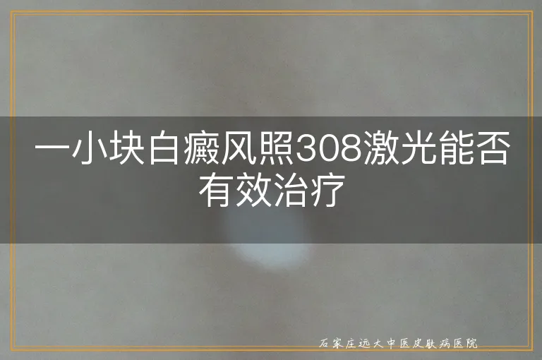 一小块白癜风照308激光能否有效治疗