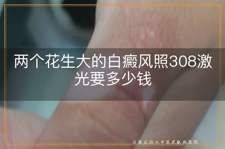 两个花生大的白癜风照308激光要多少钱