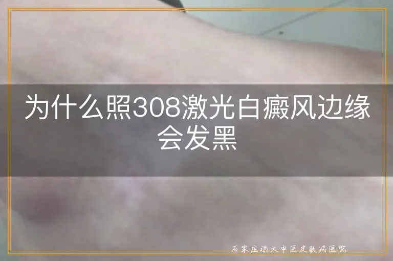 为什么照308激光白癜风边缘会发黑