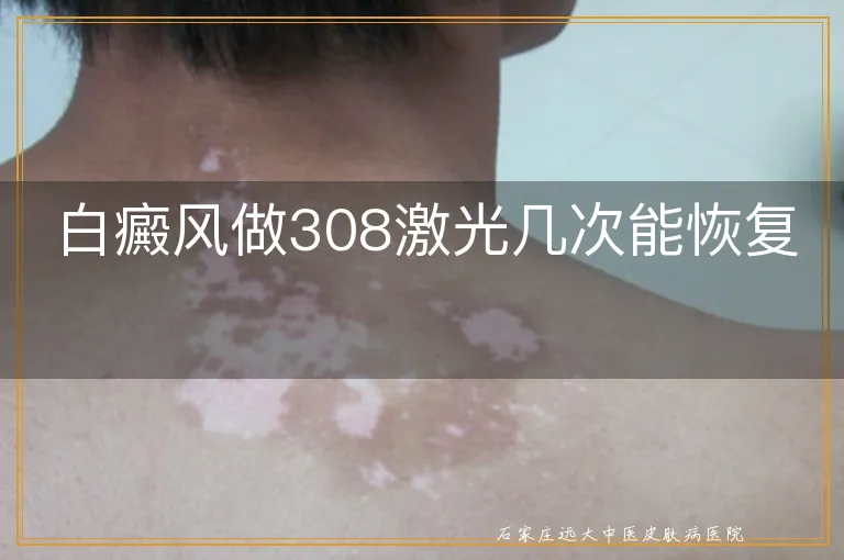 白癜风做308激光几次能恢复