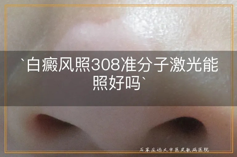 `白癜风照308准分子激光能照好吗`