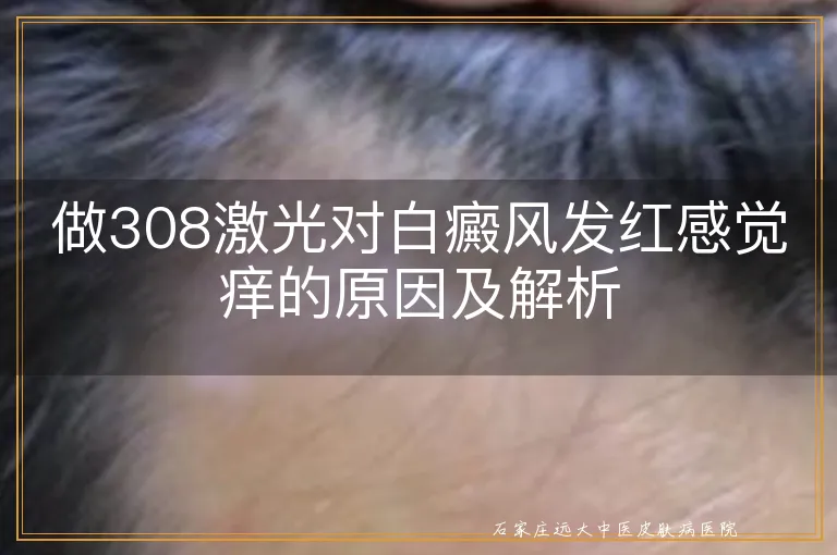 做308激光对白癜风发红感觉痒的原因及解析