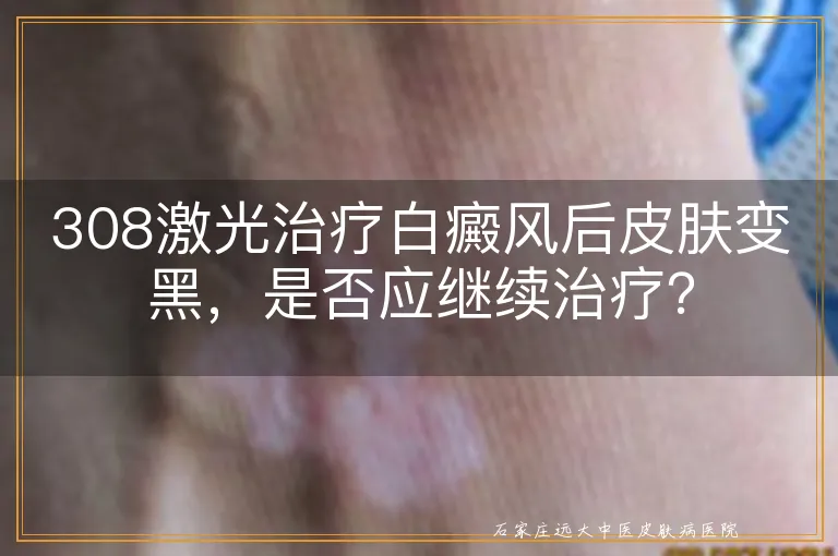 308激光治疗白癜风后皮肤变黑，是否应继续治疗？