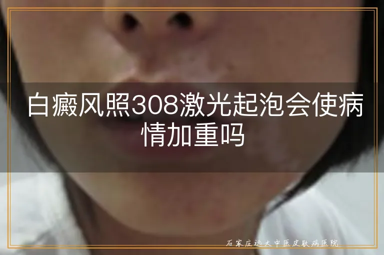 白癜风照308激光起泡会使病情加重吗