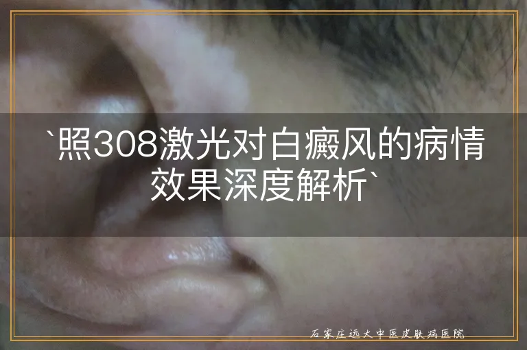 `照308激光对白癜风的病情效果深度解析`