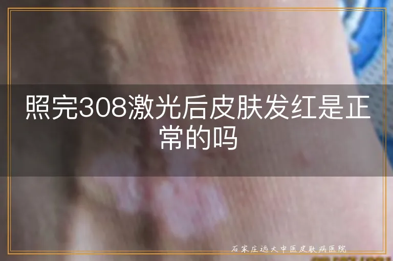 照完308激光后皮肤发红是正常的吗