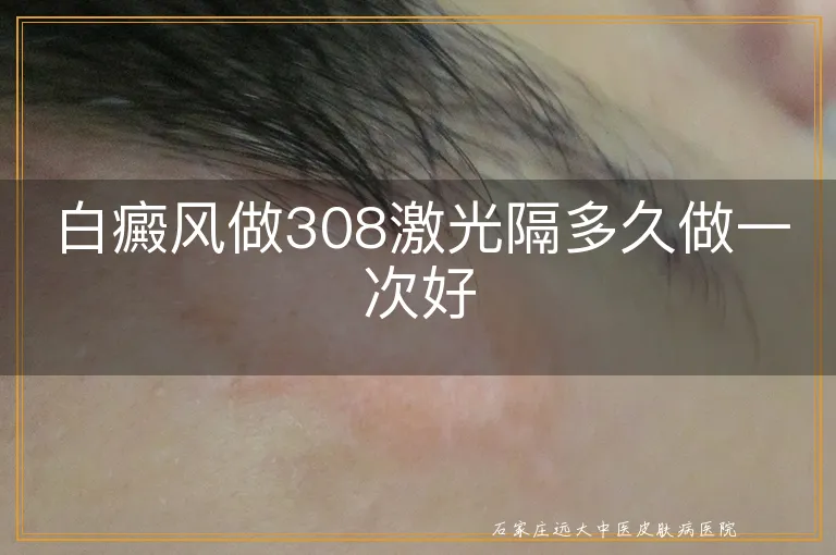 白癜风做308激光隔多久做一次好